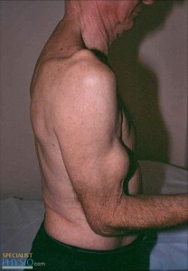Rupture of right long head of biceps1