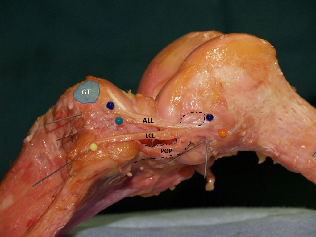 Anterolateral Ligament (ALL)