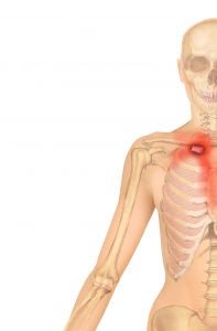 Costoclavicular ligament Pain Referral Pattern