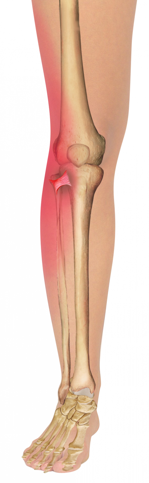 Proximal Tibiofibular Joint: a Forgotten Articulation