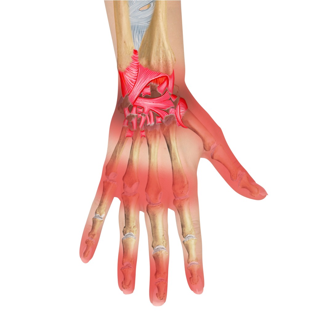 Carpal Tunnel Syndrome