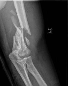 Comminuted Fracture distal Humerus